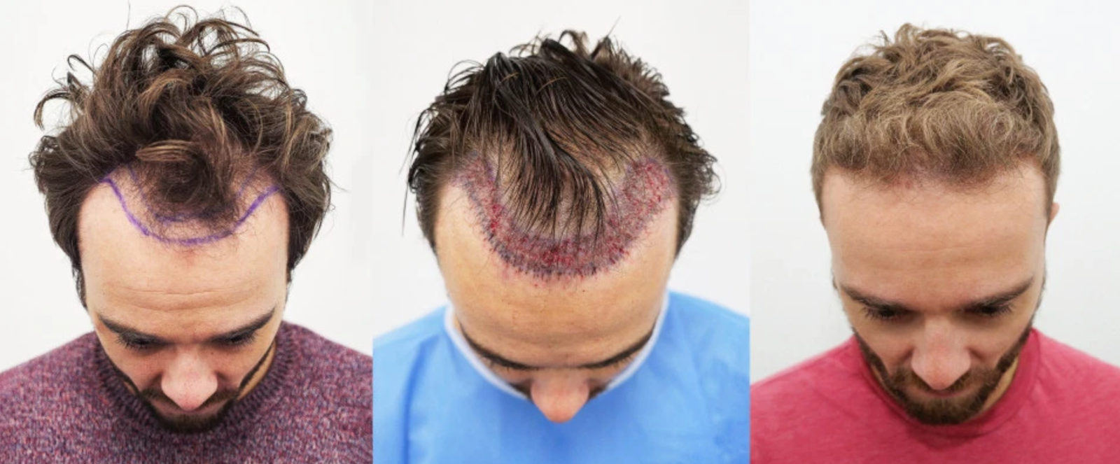 3. Crown Hair Transplant Procedure - wide 4