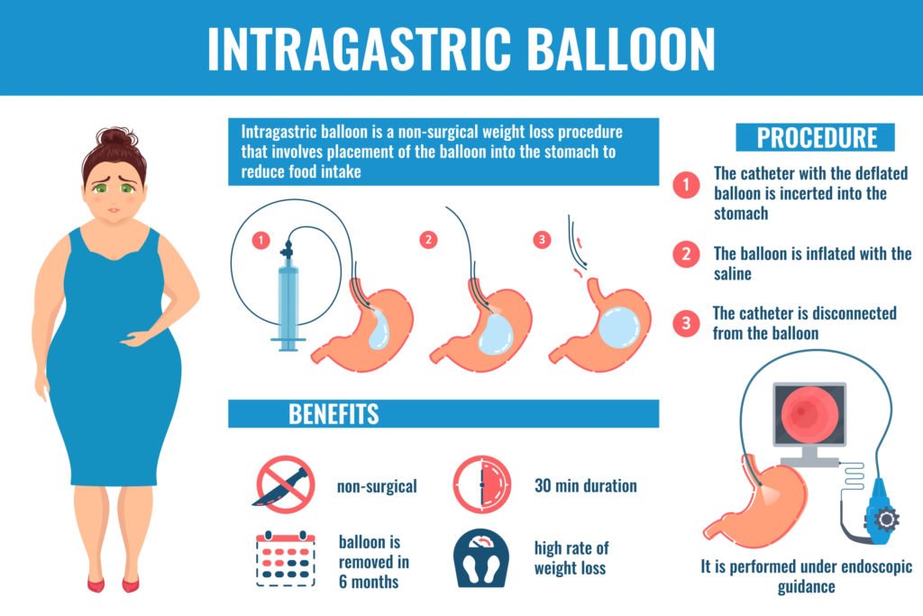 Gastric Balloon in Turkey