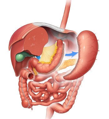 Sleeve gastrectomy in Turkey