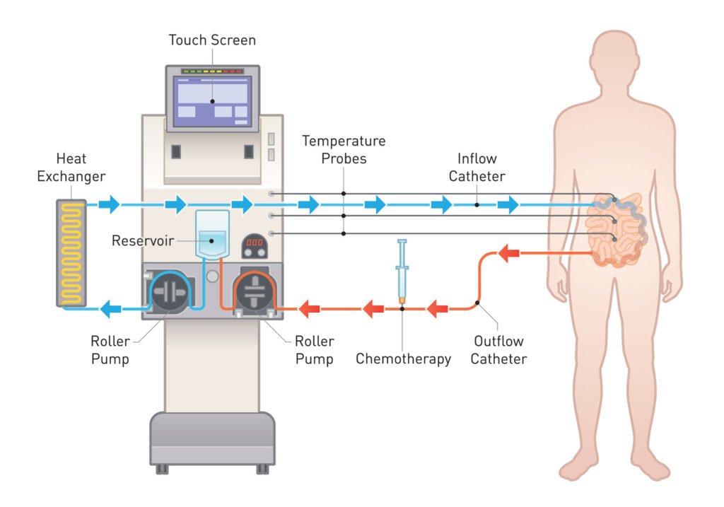 HIPEC device