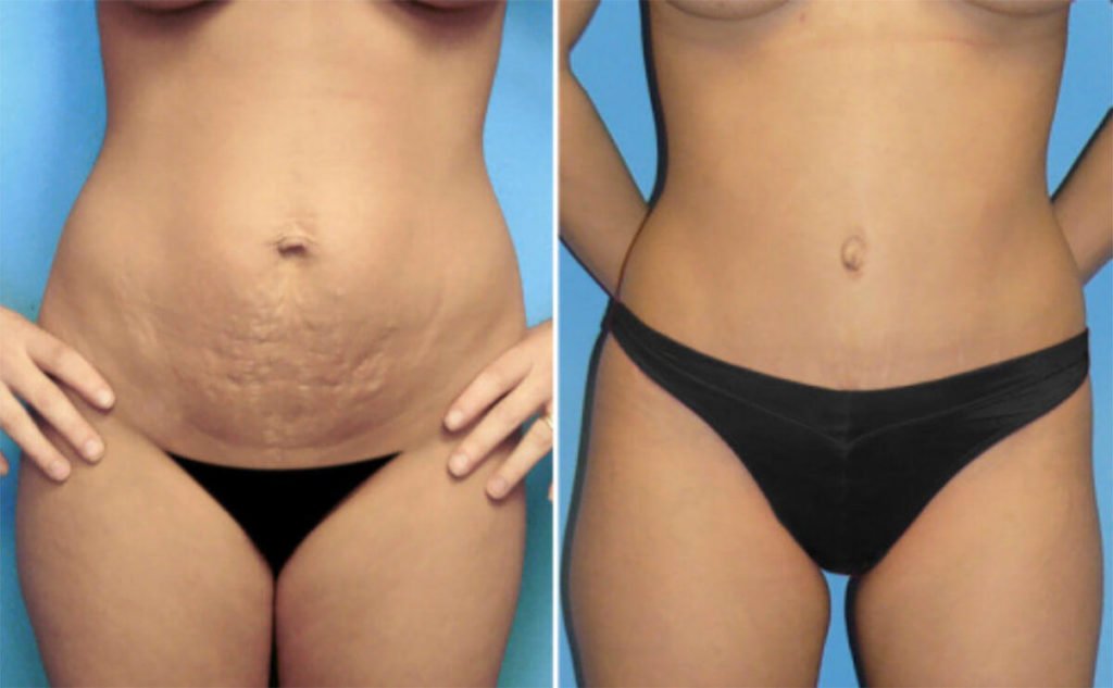 Bikini incision tummy tuck