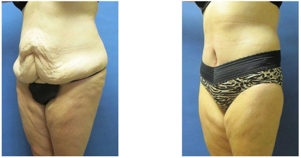 Tummy Tuck Surgery before after