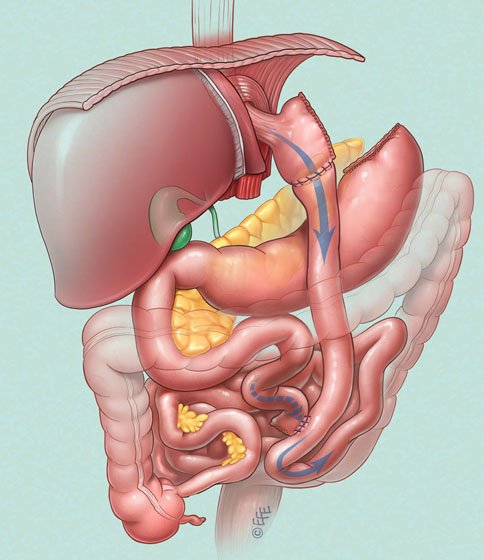 Gastric Bypass Figure 01