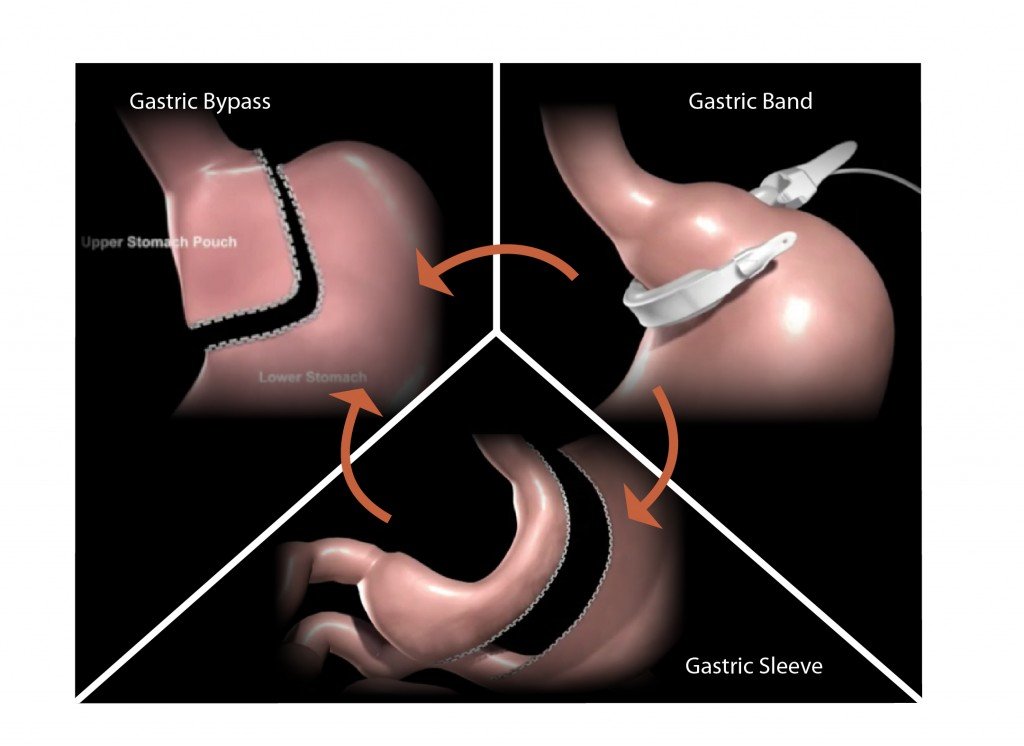 Revision Bariatric Surgery Fig 01